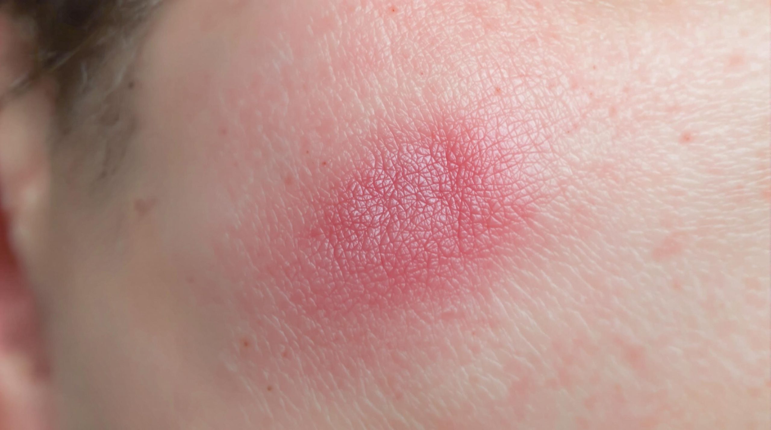 Cicatrice boursouflée après opération : causes, traitements et conseils - Instant Beaute Bien Être
